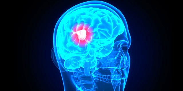 Israel Discovers New Therapy For Brain Cancer