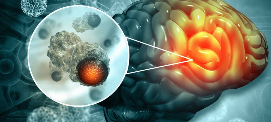 New Israeli Technique Eradicates Some Brain Tumors